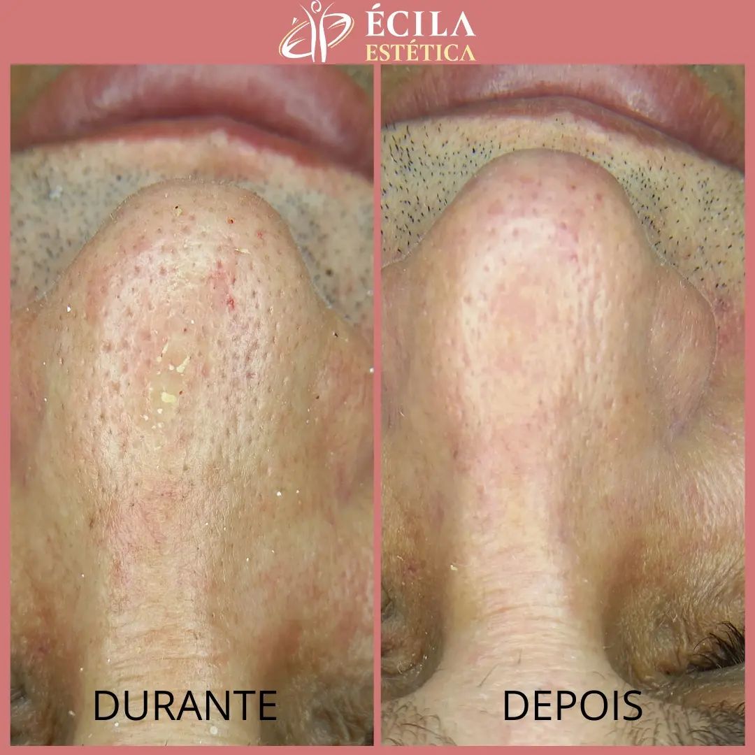 limpeza-de-pele-sobradinho-2