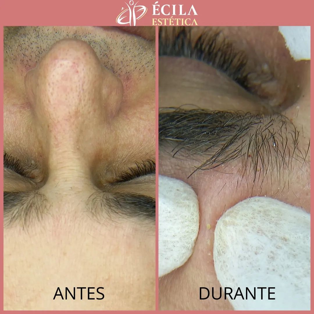 limpeza-de-pele-sobradinho-3