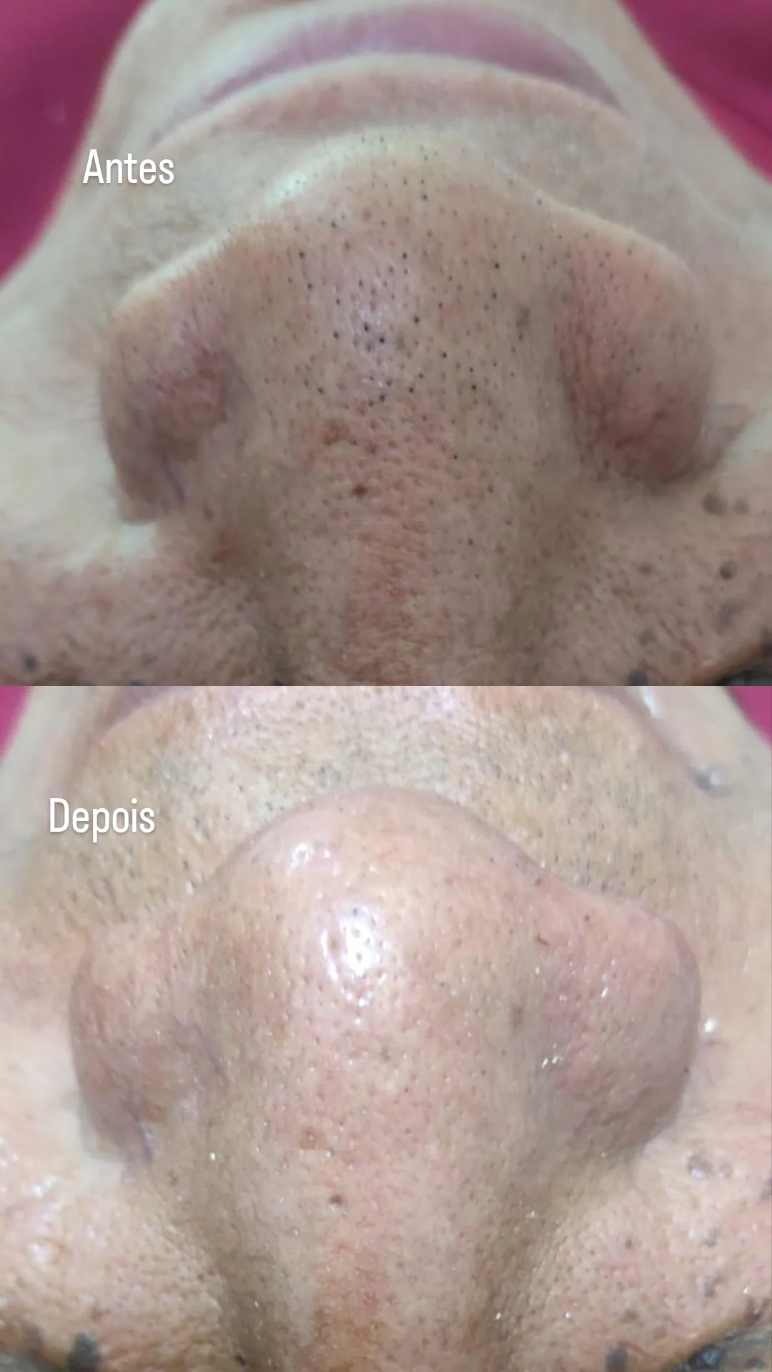 limpeza-de-pele-sobradinho-6