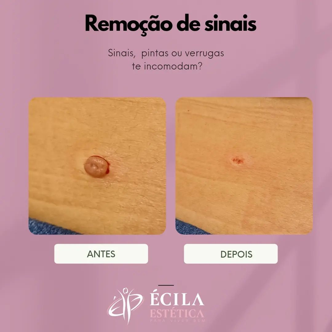 remocao-sinais-pintas-sobradinho-1