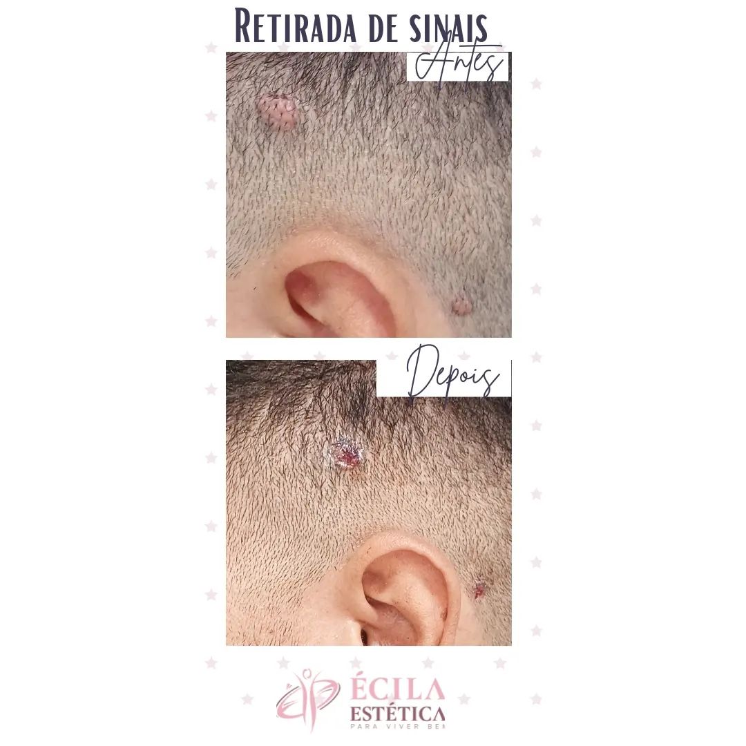 remocao-sinais-pintas-sobradinho-2