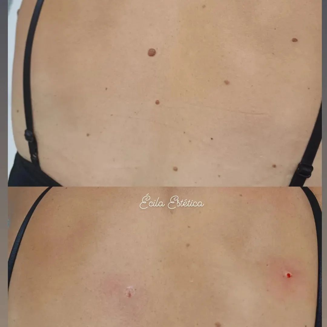 remocao-sinais-pintas-sobradinho-3