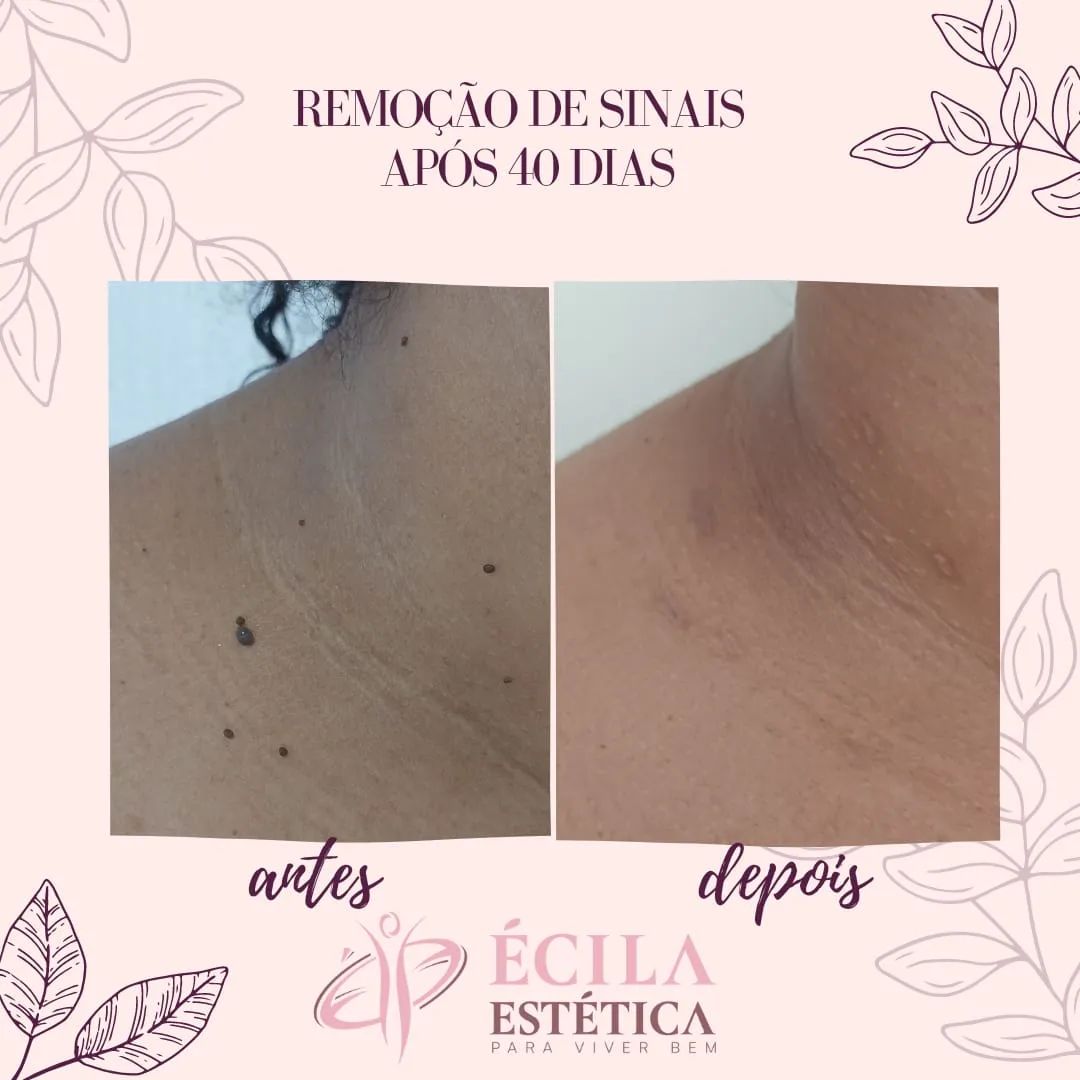 remocao-sinais-pintas-sobradinho-4